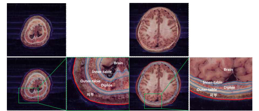 머리부분 단층 영상에서 피부, 피질골, 해면골의 구역화