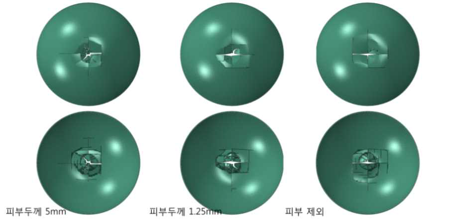 피부의 두께가 두개골의 골절에 미치는 영향: 시험조건 1