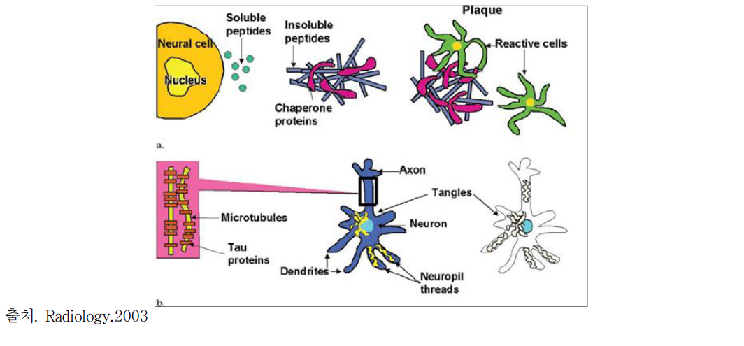 senile plaque 와 neurofibrillary tangles