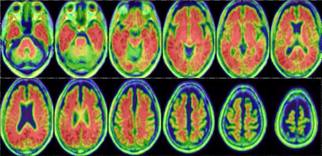 1상 임상시험에서 알츠하이머치매환자의 [18F]FC-119S PET 영상–피질섭취 증가