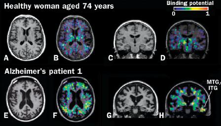 정상인 (위)과 알츠하이머 치매(아래)에서 [11C]PK 11195 영상