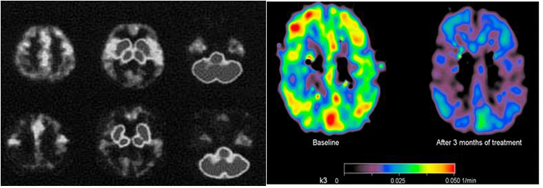 (왼쪽)-정상인(윗줄) 과 알츠하이머 치매(아랫줄)에서 [11C]MP4A PET. Lancet.1997. 그림 (오른쪽)-치매 환자에서 galantamine 치료 전 (좌측) 및 치료 3개월 이후 (우측)