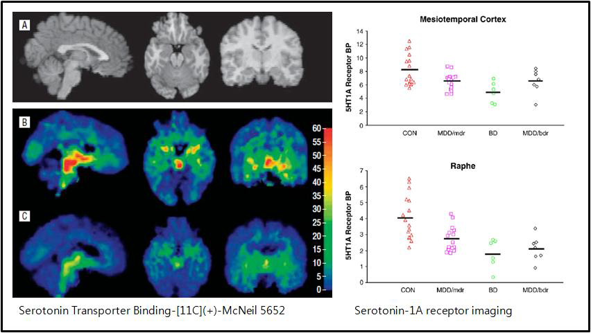 왼쪽:정상인 (B) 와 bipolar disorder 환자 (C) 의 serotonin transporter binding potential. Arch Gen Psychiatry.2007. 오른쪽: 정상인과　우울증, 조울증 환자에서의 Regional 5-HT1AR binding.