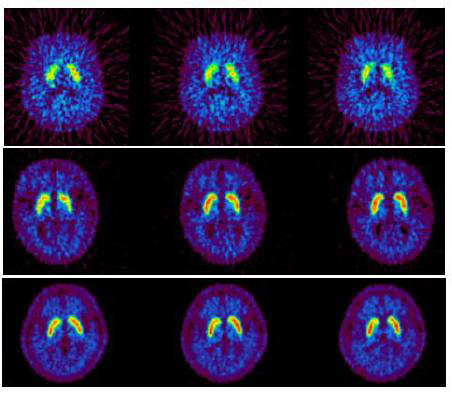 PET images of [11C]raclopride. 윗줄은 심한 BPSD, 중간줄은 경한 BPSD를 보이는 환자, 아랫줄은 정상인