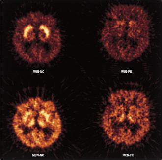 정상인 (NC) 와 파킨슨환자 (PD)에서 각각 serotonin transporter and dopamine transporter Radioligand binding ( dopamine transporterー＞[11C]WIN35 428, [11C]McN(+)5652)ー＞Serotonin transporter