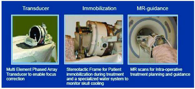 MR-HIFU 시스템. HIFU(왼쪽)을 환자의 머리에 고정하고(가운데) MRI로 실시간 관찰하며 시술한다(오른쪽)