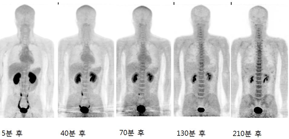 정상인 피험자에서 시간대별 F-18 FMT 전신 PET/CT 영상