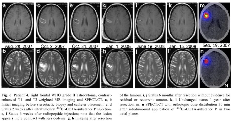 악성뇌종양에서 방사성동위원소 주입치료 후 추적관찰