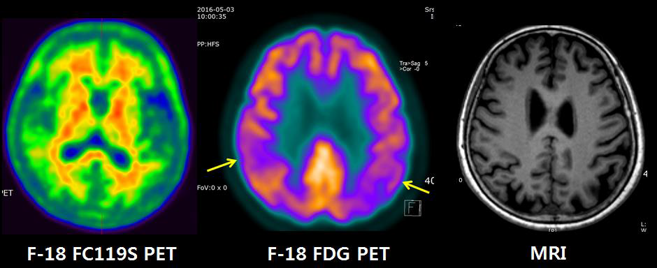 경도인지장애 환자에서 촬영한 F-18 FC119S 뇌부위 PET/CT, F-18 FDG 뇌부 위 PET/CT 및 뇌부위 MRI 영상. F-18 FC119S PET은 음성이나, F-18 FDG PET과 MRI는 양성