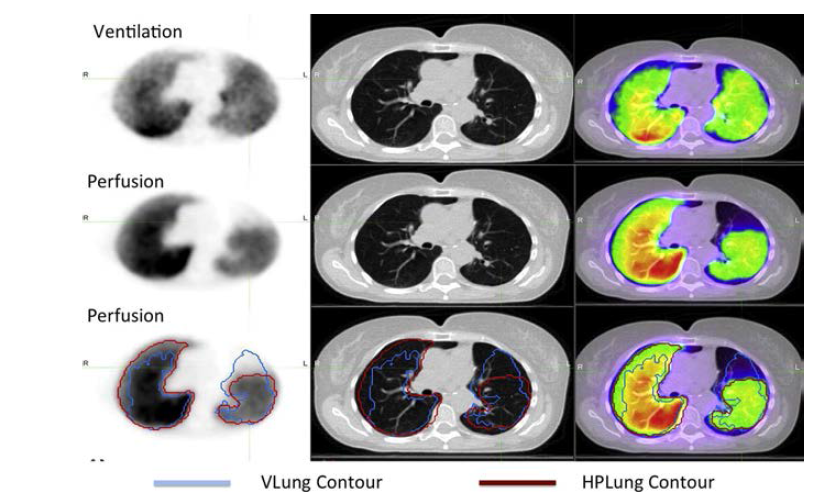 폐기종 (emphysema) 환자의 PET/CT ventilation 및 perfision 영상화