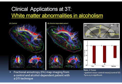 DWI 영상을 활용한 알콜중독 환자의 백질변화 연구