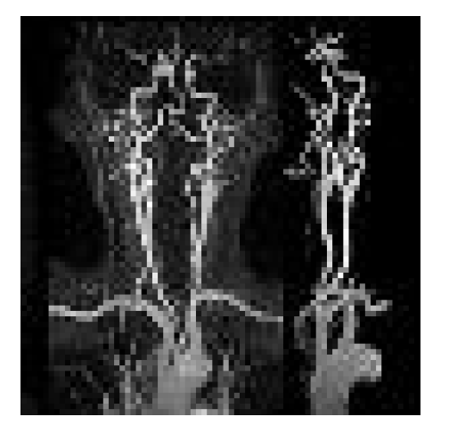 3.0T MRI 시스템을 이용한 관류강조영상