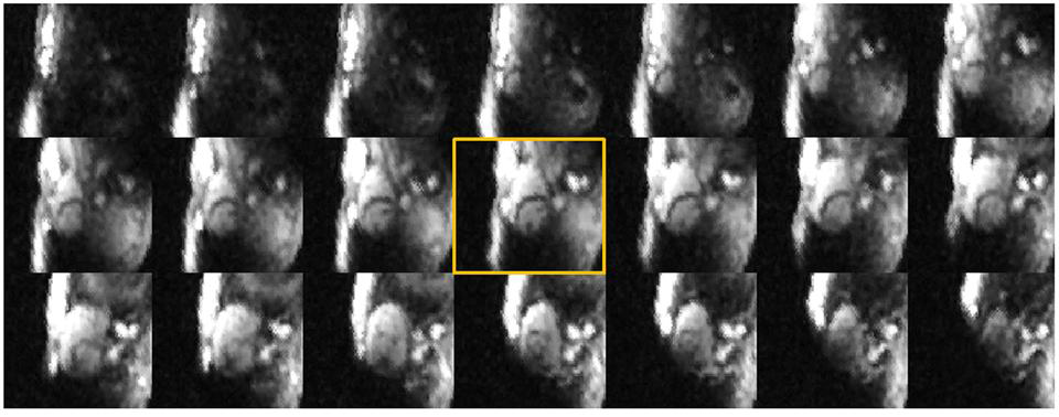 초고자장 MRI 시스템을 이용한 심장 나트륨 영상화