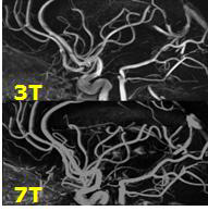 TOF MRA기법을 사용한 초고자장 MRI 뇌혈관 영상