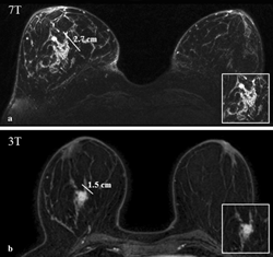 초고자장 MRI 시스템을 이용한 유방암 영상화