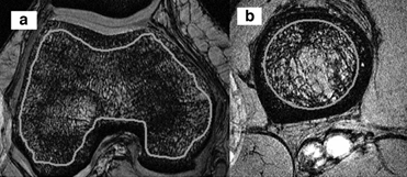 초고자장 MRI 시스템을 이용한 골밀도 영상화