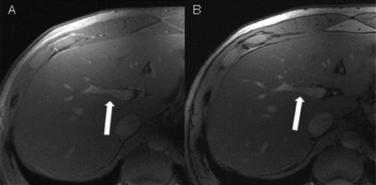 초고자장 MRI 시스템을 이용한 물과 기름이 구분된 7T 간 영상