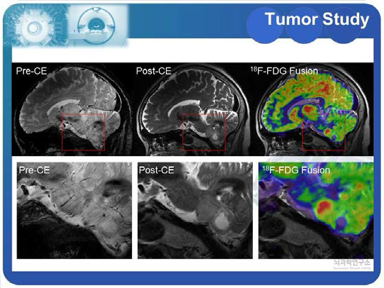 18F-FDG 주사한 종양 환자의 7.0T MRI와 PET 시스템을 이용한 영상화