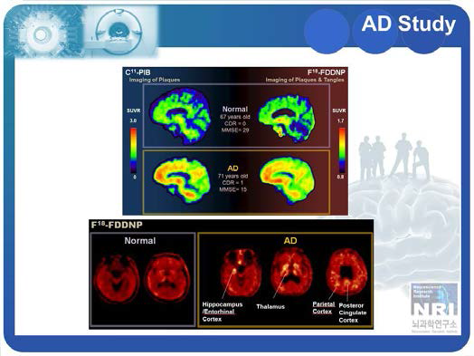 알츠하이머환자의 PET/MRI 영상화