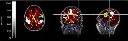 고자장 MRI/PET 시스템의 T1, DTI, fMRI, [18F]FETPET이 정합된 다기능 융합영상화
