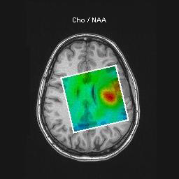 spin echo weighted CSI 기법으로 측정된 Cholin / N-acetyl aspartate 영상화