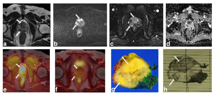 PET/MRI 시스템을 이용한 전립선암환자의 융합영상화