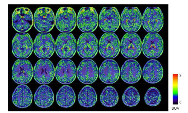 사이클로스포린을 주사후 뇌 영역 PET/MRI 융합 영상화