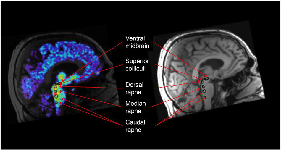 뇌간 MRI 및 [11C]MADAM PET 융합 영상화 및 관심볼륨의 설정