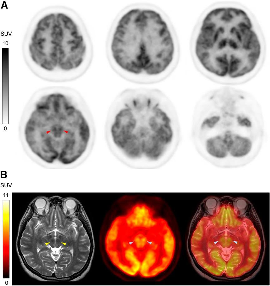 뇌의 HRRT를 이용한 18F-FDG PET 영상화 및 3T T2W MRI 용합영상화