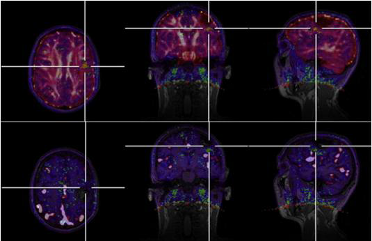 3 T MAGNETOM Tim-Trio MR 및 BrainPET 이 결합된 MR/PET 스캐너를 이용한 뇌종양 융합영상화