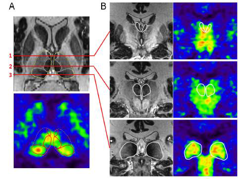 7.0T MRI 및 11C DASB HRRT-PET를 이용한 사상 영상화