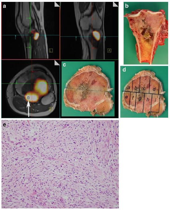 골연부 종양환자의 PET/CT와 MRI 융합영상에서 가장 높은 대사능을 보이는 종양의 해부학적 위치를 확인한 뒤, 항암 화학요법 및 수술 후 조직에서 해당 영역의 조직학적 반응을 평가함