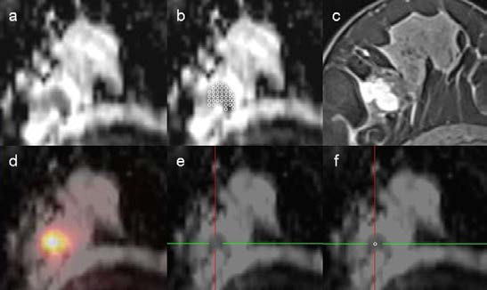 MRI (a-c)와 PET의 융합영상 (d)으로부터 가장 높은 대사능을 보이는 종양 영역 (e)을 정할 수 있으며, 여기서 ADC 값을 측정함 (f)