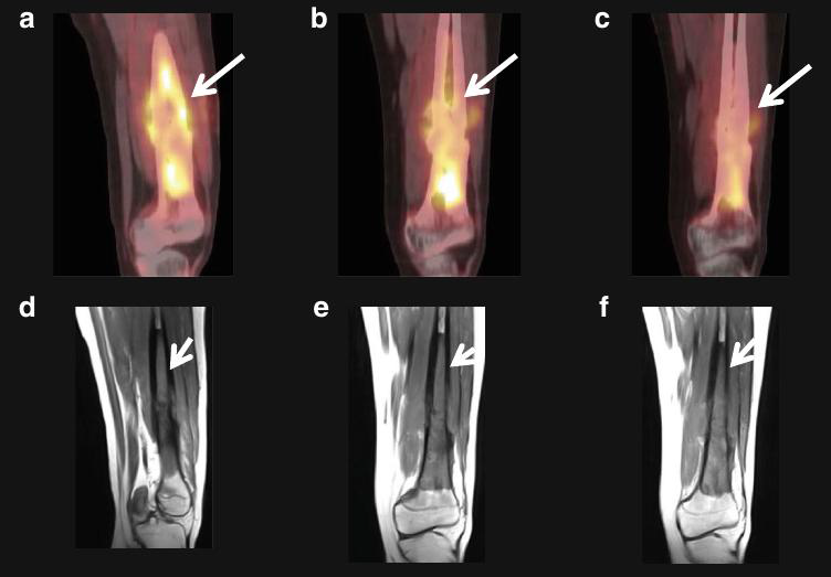 골육종의 항암치료 전 (a, d), 1주기 항암치료 후 (b, e) 및 2주기 항암치료 후 (c, f) FDG　PET/CT (위)와 MRI (아래)