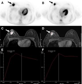 수술 전 항암화학요법 전(왼쪽)과 후(오른쪽) 18F-FDG PET/CT로 측정한 종양 의 대사능(A, B)과 조영증강 MRI(C, D)에서 측정한 종양의 혈류(E, F)