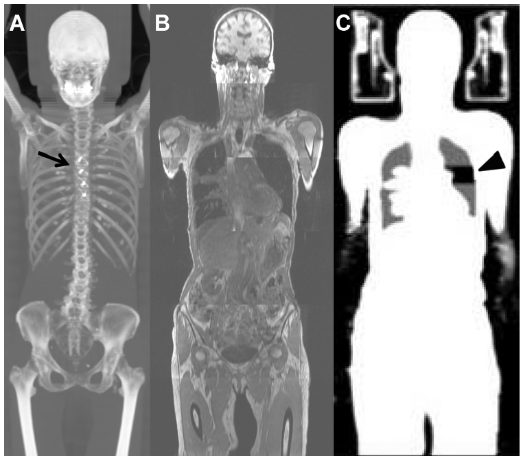 CT의 Maximum intensity projection 영상(A), 영상에서 표시된 화살표는 복장뼈절개술 (sternotomy) wire를 나타냄. MRI T1 영상 (B), PET/MRI로 획득된 attenuation map(C). 해당 영상에서 검은색 삼각형으로 가리키는 부분이 영상의 artifacts를 나타냄