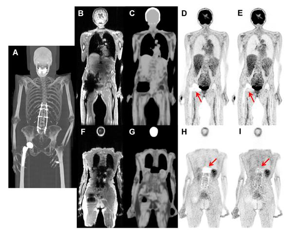 Maximum intensity projection CT 영상(A), PET/MRI를 이용한 T1-w Dixon 영상(B, F)과 attenuation map (C, G), non-TOF PET 영상(D, H)과 TOF-PET 영상(E, I)