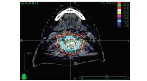 Example of a circumferential treatment plan for a patient treated with 3000 cGy in 5 fractions.