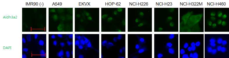 NSCLC에서 ALDH3A2 isoform 단백질 발현 정도를 IFC로 분석하였다.