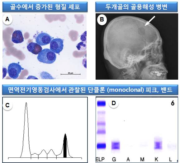 다발성 골수종의 (A) 비정상 형질세포인 골수종 세포 (Wright-Giemsa stain, x1000), (B) 두개골의 골용해성 병변 (C,D) 면역전기영동검사에서 관찰된 단클론 (monoclonal) 피크 및 밴드