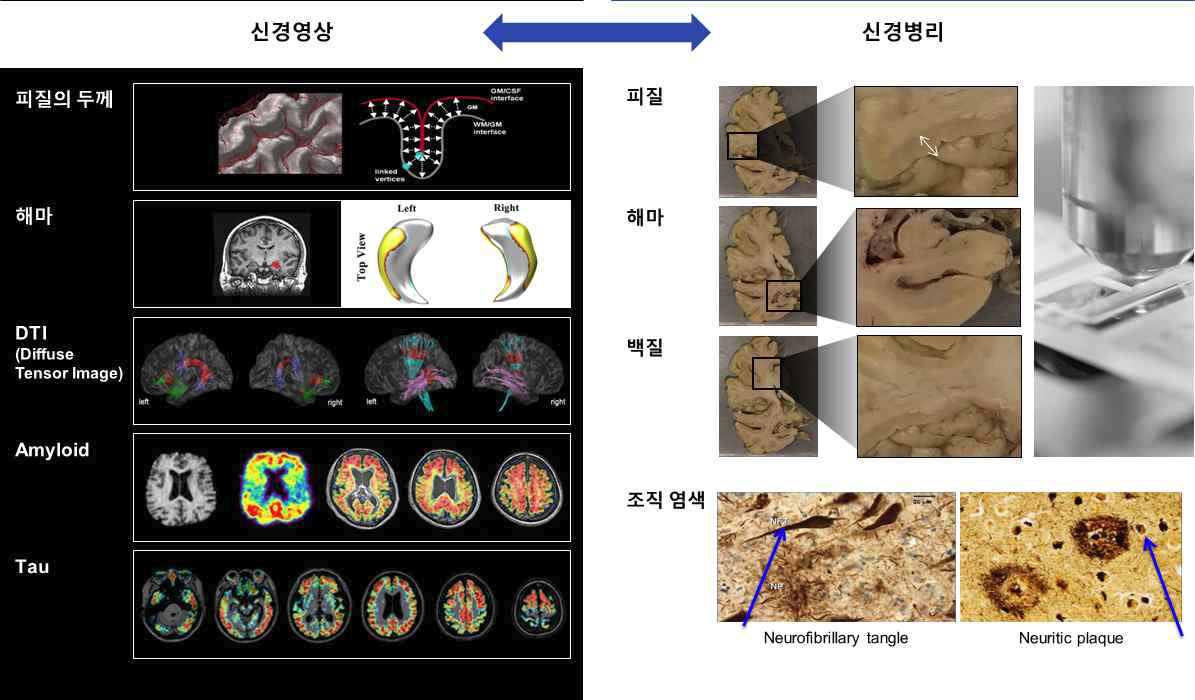 신경병리와 뇌영상 관련성 연구
