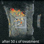 MR temperature image artifacts of an in vivo porcine liver induced by a respiratory motion: a white arrow represents a RF heating spot but incorrect heating zones appear in the upper region outside the heating spot