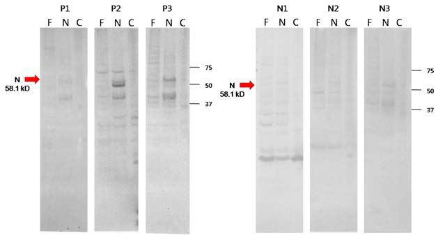 Anti-Measles IgM이 양성인 환자 혈청(P1-P3)와 음성인 혈청(N1-N3)를 이용하여 곤충세포로부터 발현된 measles Fusion protein, measles Nucleoprotein에 대한 항원성 분석