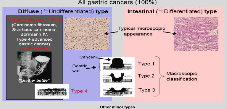 Classification of gastric cancer into 2 major histopathological categories (intestinal-type and diffuse-type gastric cancer)