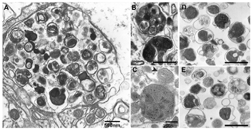 치매환자 뇌에서 관찰되는 Autophagy vacuole 의 축적