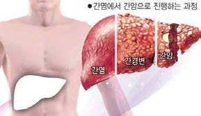 간염에서 간암으로 진행하는 과정