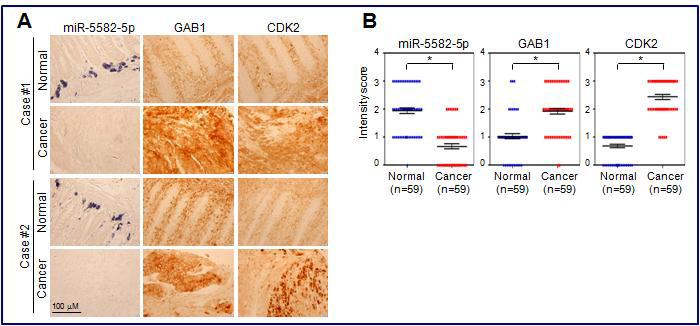 대장암 및 주변 정상 조직에서의 miR-5582-5p 및 타겟단백질 발현량 비교