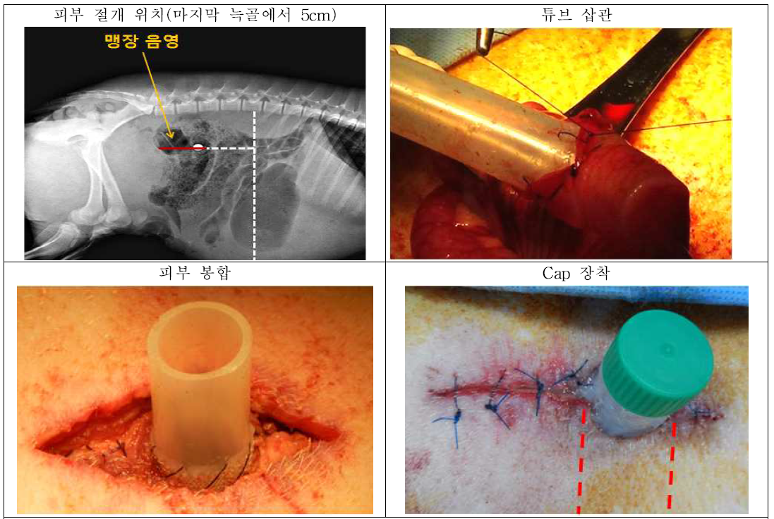 삽관형 Ostomy 관리기 장착을 위한 수술법