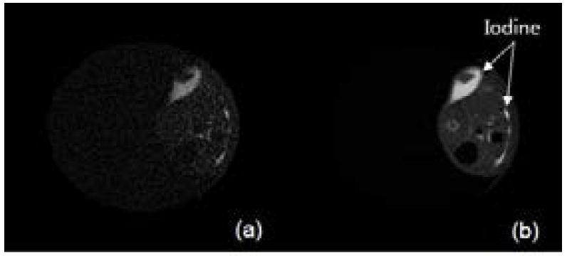 (a) Soft tissue가 제거된 Iodine CT 영상, (b) 일반적인 CT 영상.