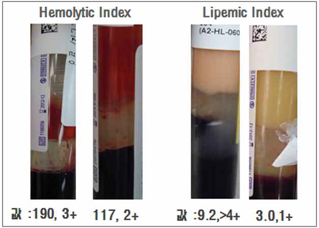 Serum index 분석 예